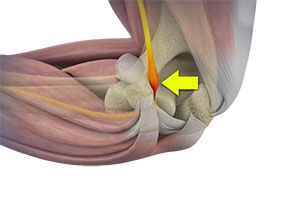 Cubital Tunnel Syndrome