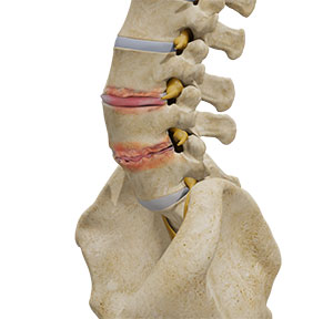 Degenerative Disc Disease
