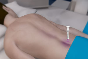 Epidural Steroid Injections 