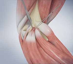 Golfer’s Elbow