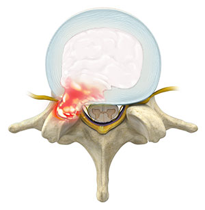 Herniated Disc