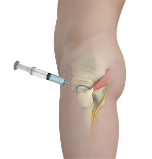 Hip Steroid Injection