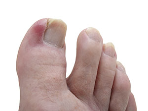 Ingrown Toenails