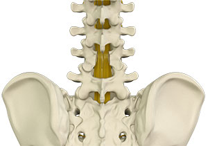 Laminectomy 