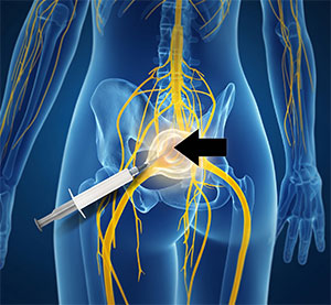 Pelvic Plexus Blocks