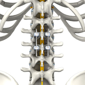 Spinal Fusion