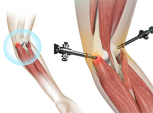 Tennis Elbow Surgery