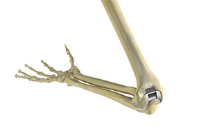 Total Elbow Replacement