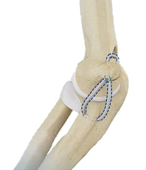 UCL Reconstruction (Tommy John Surgery)