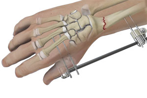 Wrist Fracture Fixation