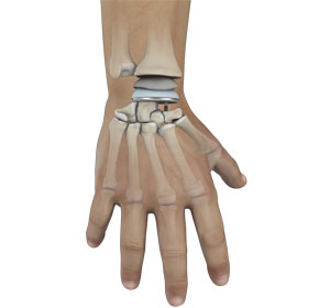 Wrist Joint Replacement