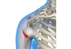 Anterior Shoulder Instability