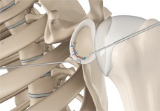 Arthroscopic Bankart Repair