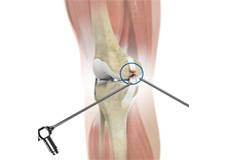 Arthroscopic Reconstruction of the Knee for Ligament Injuries