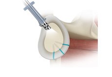Complex Shoulder Reconstruction