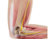 Cubital Tunnel Syndrome