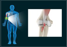 Distal Biceps Injuries