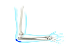 Elbow Dislocation