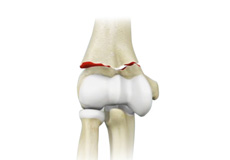 Elbow Fractures