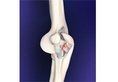 Elbow Ligament Injuries