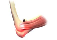 Elbow Sprain