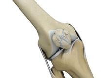 Knee Fracture Surgery