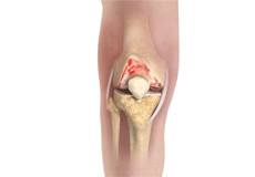 Knee Osteoarthritis