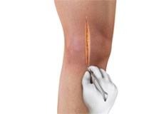 Knee Surgery