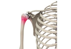 Little League Shoulder