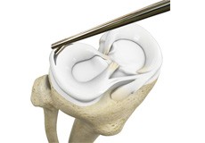 Meniscectomy