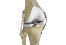Multiligament Reconstruction of the Knee