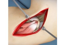 Open Elbow Surgery