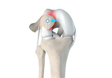 Patellar Tracking Disorder