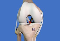 Revision ACL Surgery