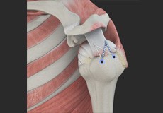 Rotator Cuff Repair