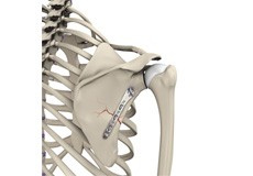Shoulder Fracture Care