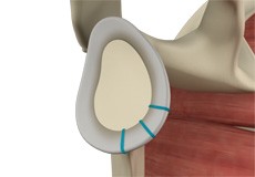 Shoulder Labrum Reconstruction