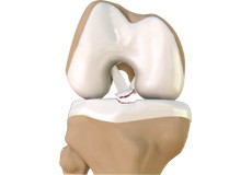 Tibial Eminence Fracture