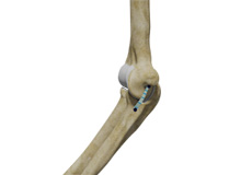 Ulnar Collateral Ligament Repair with Internal Brace