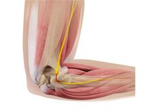 Ulnar Nerve Release