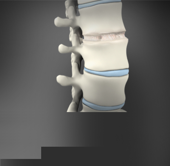 Anterior Lumbar Interbody Fusion