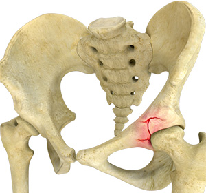 Acetabular Fracture