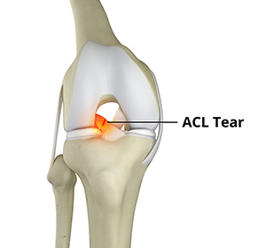 ACL Tears