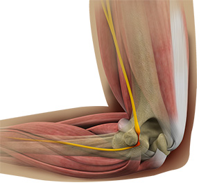 Cubital Tunnel Release