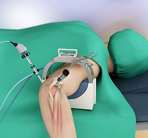 elbow-arthrocopy