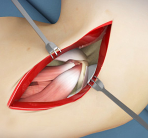 elbow-surgery