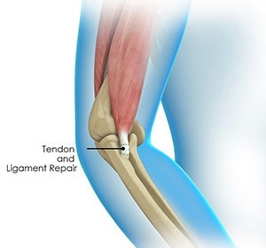 elbow-tendon-and-ligament-repair