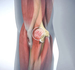 golfers-elbow
