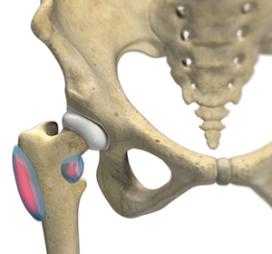 Hip Bursitis