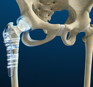 hip-fracture-surgery